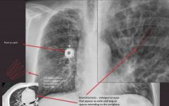 "Mixed airway disease and fibrosis from chronic infection - bronchiectasis

Long-ballooned bronchioles - tram-tracking

Bonus: Port-o-cath going into the right atria"