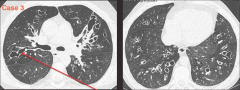Bronchiectasis - visible dilated bronchioles