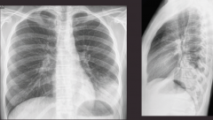 "Left lower lobe pneumonia

White mass on left lower lobe, same density as diaphragm (silouette sign), can see bronchi through the opacity (air bronchogram)"