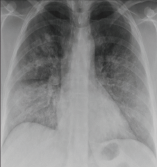 Take a look at the x-ray. What is your diagnosis?