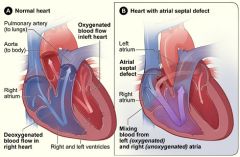 1. ostium secundum- central portion of the septum
2. oxygenated blood from the LA goes thru ASD into RA which leads to increased pulm. blood flow and inc work of right side of heart. As the shunt size inc, RA and RV dilatation occur. Pulm HTN is ...
