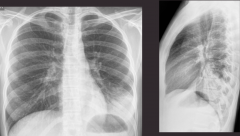 A 35 y.o. man is presenting with a fever. Take a look at the x-ray. What is your diagnosis? What are the abnormalities?
