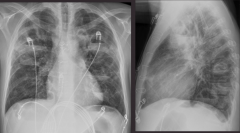 An IV drug user presents with a fever. Take a look at the x-ray. What is your diagnosis? What are the abnormalities.