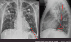 "Tuberculosis

Circular abcess in the left lower lobe that is filled halfway with fluid (likely exudate), there are all kinds on the AP to the left if you look closely."
