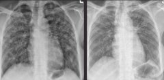 The x-rays are of a 35 y.o. woman with sarcoid. The film on the left is at diagnosis. The film on the right is four years later. What has changed on the x-ray?