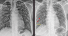 "At diagnosis - patchy, bilateral, symmetric densities.

4 years later - webs of lines, more linear, trachea deviated, diaphragms pulled up.

All signs point to interstital disease and fibrosis, pulling on the structures."