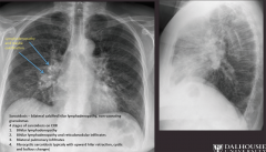 "Sarcoidosis -bilateral calcified hilar lymphadenopathy, non-caseating granulomas

Four stages of sarcoidosis on CXR
1. Bihilar lymphadenopathy

2. Bihilar lymphadenopathy and reticulonodular infiltrates

3. Bilateral pulmonary infiltrates
...