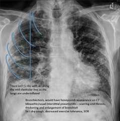 "Idiopathic pulmonary fibrosis (IPF) - aka Usual interstital pneumonitis (UIP)

Linear densities, hypoinflation (4.5 anterior ribs), shaggy heart and diaphragms"