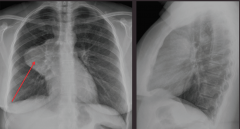"Mediastinal mass.

Silouette sign with the mediastinum, lateral view shows an anterior mass"