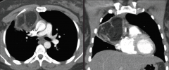 Take a look at the CT. What is the differential diagnosis for something like this?