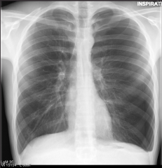 A 20 y.o. male presents with chest pain. Take a look at the x-ray. What is your diagnosis? What are the abnormalities?