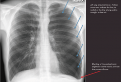 "Left-sided pneumothorax.

Faint lung outline on the left side, blunting of the left costophrenic angle."