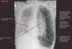"Left tension pneumothorax.

Collapsed lung, structures pushed to the right (trachea, heart)"