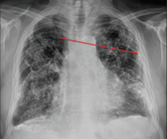 "Pleural plaques.

Densities in the lung periphery, on the surface of the diaphragm.

Often caused by asbestos exposure."