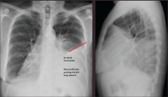 "Malignant pleural effusion, secondary to breast cancer.

L lower lobe density, fluid forming a meniscule line,"
