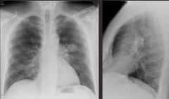 A 62 y.o. smoker presented to his family doctor due to confusion and found to have hypercalcemia. Take a look at the x-ray. What is your diagnosis? What are the abnormalities?
