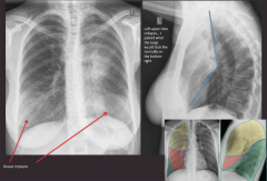 "Left upper lobe collapse.

Air on the lateral where the upper lobe should be, collapsed lung shows up as a white density."