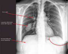 "Right lung mass, likely from breast cancer mets.

Density in R lung, port-o-cath, right breast missing"