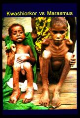 1. Marasmus patients suffer from a peeling and alternately pigmented skin. Kwashiorkor patients are characterized by a distended stomach, burns on the skin and diarrhea.
2. Marasmus affects kids because of a lack of nutritional elements in the di...