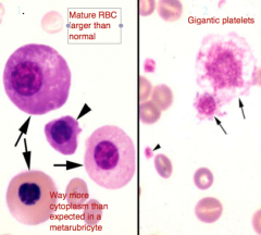 1. Dysplastic erythroid cells (1) & dysplastic giant platelets (2) suggest what Dx.?
2. If this was a cats BM film, what induced it?
