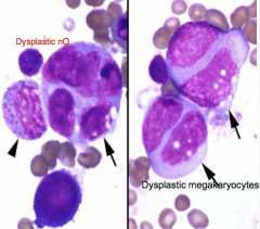 1. Dysplastic neutrophils & dysplastic megakaryocytes (2) suggest what Dx.?
2. If this was a cats BM film, what induced it?