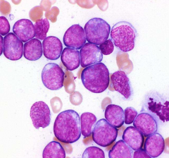 Classify leukemia (BM has 20%/> blasts):
・Very poorly differentiated myelomonocytic leukemia.
・Cannot be differentiated based on morphology from lymphoid leukemia