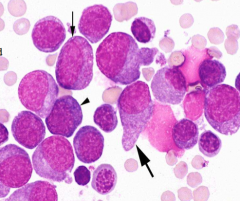 Classify leukemia (BM has 20%/> blasts):
・Cannot be classified based on morphology/cytochemistry
・Has features of both erythroid & myeloid leukemias