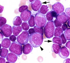 Classify leukemia (BM has 20%/> blasts):
>90% Blasts in BM
<10% more differentiated granulocyte precursors

Type I Myeloblasts (Arrows)
Type II Myeloblasts (Arrowhead)