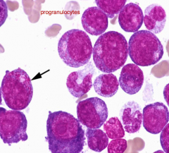 Classify leukemia (BM has 20%/> blasts):
<90% Blasts in BM
>10% more differentiated granulocytes
Many promyelocytes