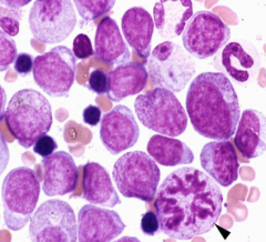 Classify leukemia (BM has 20%/> blasts):
Cells in mitosis (Arrowhead)