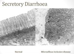 Secretory diarrhoea (osmotic gap <50)