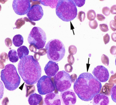 Classify leukemia (BM has 20%/> blasts):
>20% myeloblasts & monoblasts in BM
>20% monocytes & granulocytes

Monoblasts (arrows)
Progranulocytes (arrowhead)