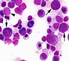 Classify leukemia (BM has 20%/> blasts):
>50% Erythroid OR if most blasts are erythroid
<20% Myeloblasts & monoblasts