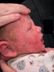 Sophie is a 7 month girl who presents to the dermatology clinic for management of her severe eczema.
She is noted to have a weight below the 3rd centile.
She is developmentally appropriate.
She is breastfed and has difficulty taking...