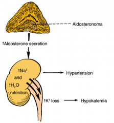 Aldesteronism (Conn's syndrome)