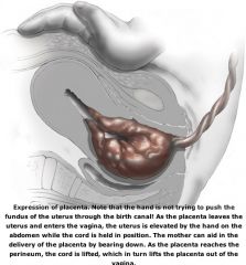What are the 3 classic signs of placental separation?