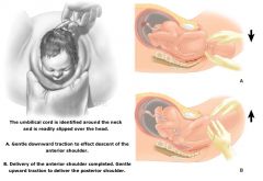 Evaluate for nuchal cord (reduce nuchal cord if needed)
Place a hand on each parietal eminence of the baby’s head
Gently use downward traction to help slip the anterior shoulder under the pubic symphysis
Deliver the rest of the baby