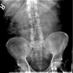 25yo F p/w epigastric pain radiating straight through to the back. Labs are notable only for markedly elevated amylase and lipase. An abdominal X-ray is taken (see Figure). What's the dx?