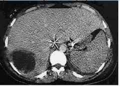 A 57 year old ill-appearing man presents with fever, chills, abdominal pain, nausea and vomiting. His abdominal CT is shown in the Figure. Which of the following is LEAST correct regarding this patient’s condition?