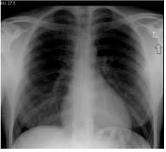The chest X-ray in the Figure was taken in an intoxicated patient who is conversant, but an unreliable historian. The X-ray findings are best described as indicating: