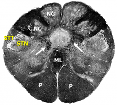 Caudal medulla.

P –pyramids
STN – spinal trigeminal nucleus
STT- spinal trigeminal tract
NG –nucleus gracilis
NC – nucleus cuneatus
ML – medial lemniscus
arrows – internal arcuate fibers