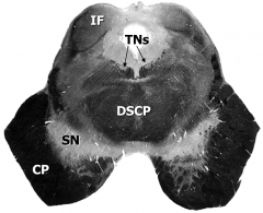 Midbrain:
IF – inferior colliculus
SN – substantia nigra
CP – cerebral peduncle
TNs – trochlear nuclei
DSCP – decussation of the superior cerebellar peduncle