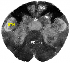 Junction of medulla and spinal cord:
PD –pyramidal decussation
STN – spinal trigeminal nucleus
NG –nucleus gracilis
NC – nucleus cuneatus