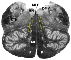 Level of inferior olive and hypoglossal nucleus:
P –pyramids
STN – spinal trigeminal nucleus
ML – medial lemniscus
MLF – medial longitudinal fasciculus
HN – hypoglossal nucleus
Hypoglossal nerve fibers – yellow outlines
DMV – ...
