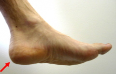 heal of foot