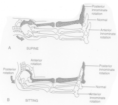 Assess Leg Length Discrepancy 

Ant Rot: Long in supine and short in sitting
Post Rot: Short in supine and long in sit