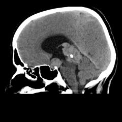 12 year old child, engulfed pituitary calcification