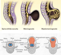incomplete neural tube closure
- no meninges herniation