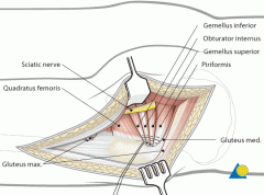 Kocher-Langenbeck approach, posterior appr
No internervous plane Incision=>1 longitudinal incision centered over greater trochanter, 2 start just below iliac crest, lateral to PSIS(-mini-incision approach shows no longterm benefits to hip functio...