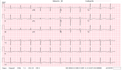 In a patient with recurrent syncope, what etiology is indicated by this ECG?